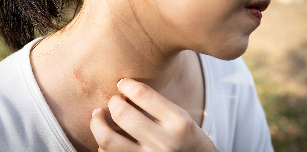 Hombro sintomas de dermatitis